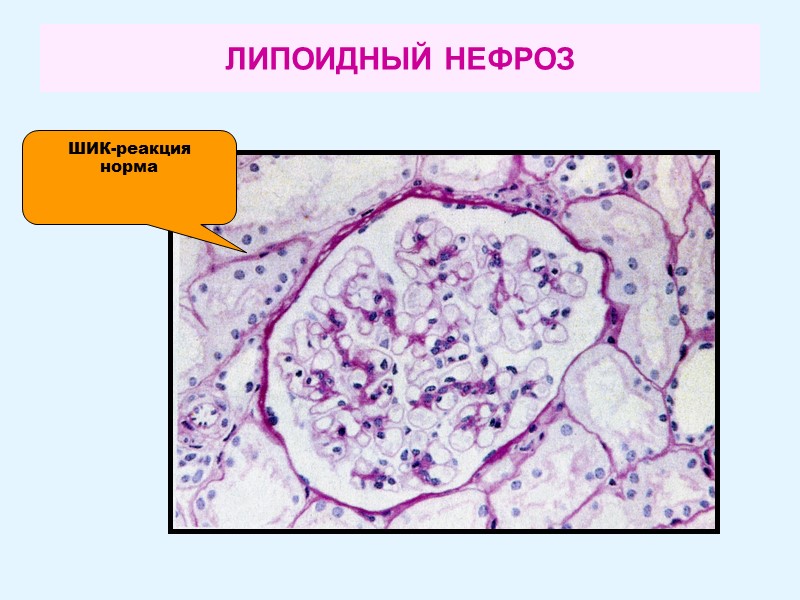 ЛИПОИДНЫЙ НЕФРОЗ ШИК-реакция норма